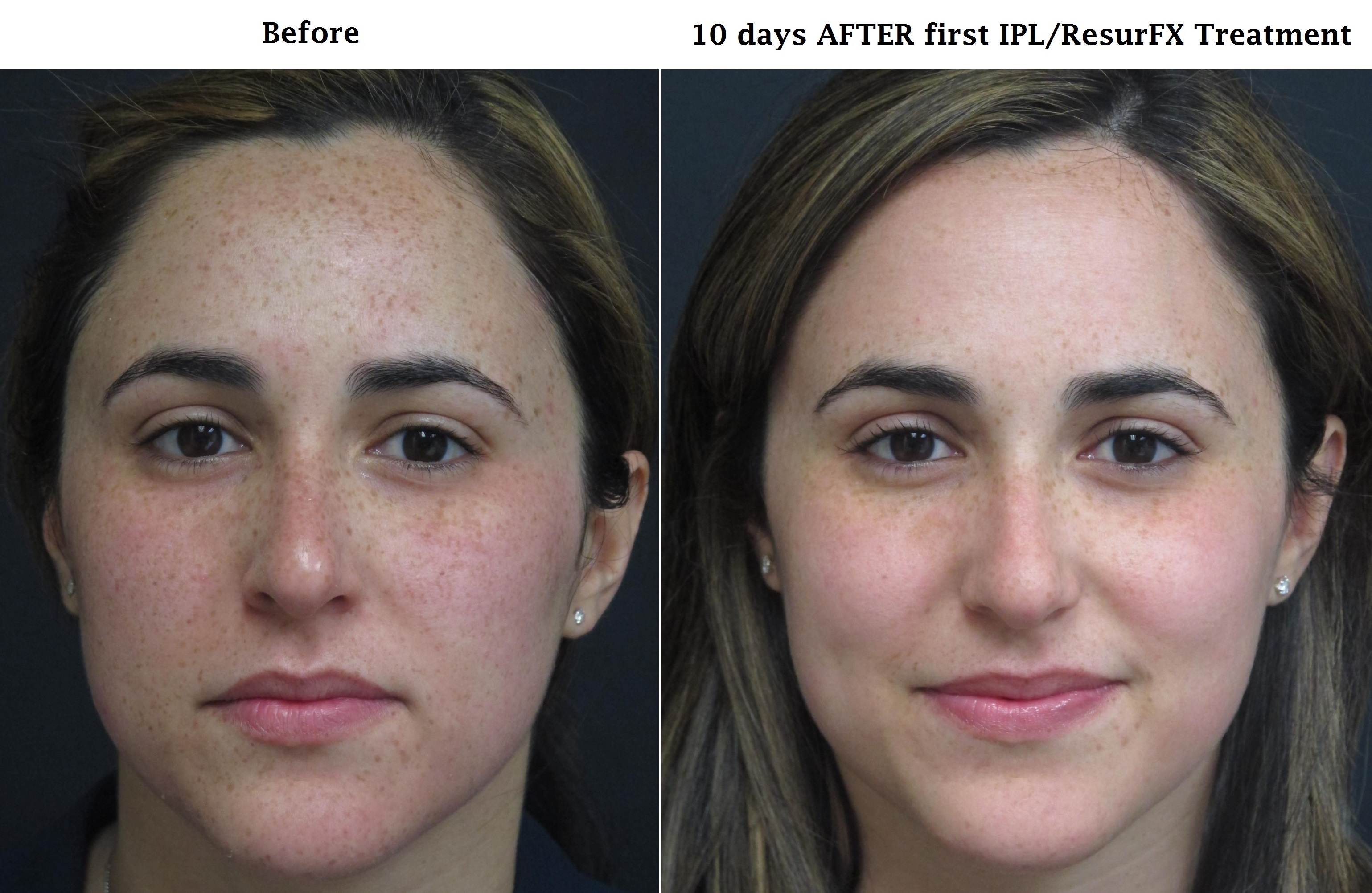 Before and After IPL/ResurFX - Central Florida Dermatology. 