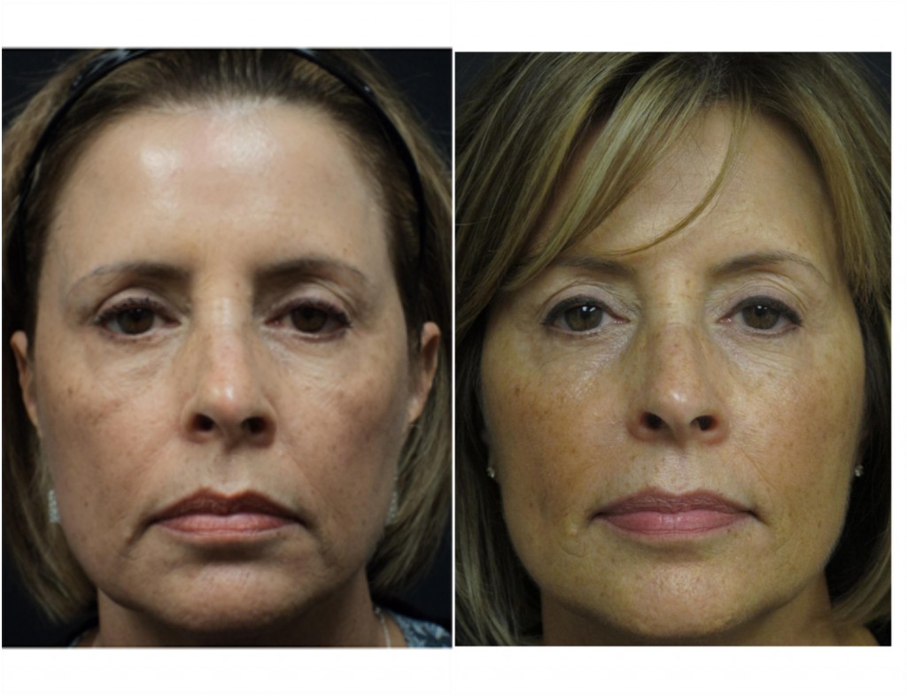 Liquid Rejuvenation Package Before and After