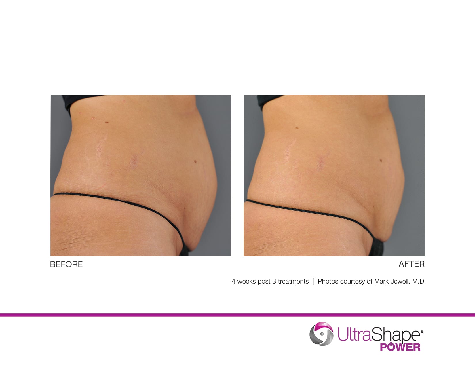 UltraShape-Power-12w-post-3tx-RAmir-MD_lowres