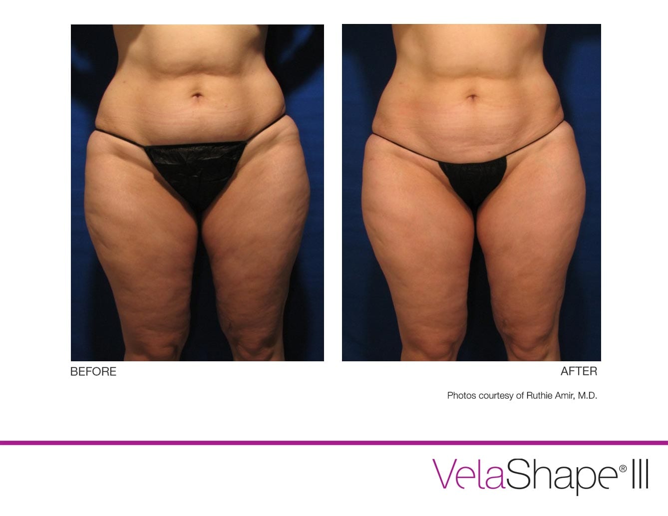 VelaShape Cellulite Reduction