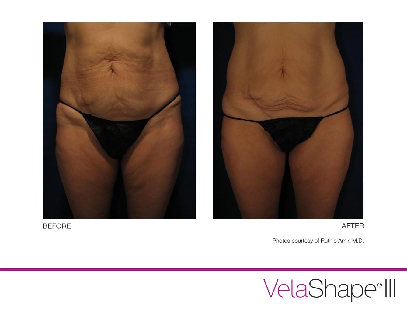VelaShape Cellulite Reduction