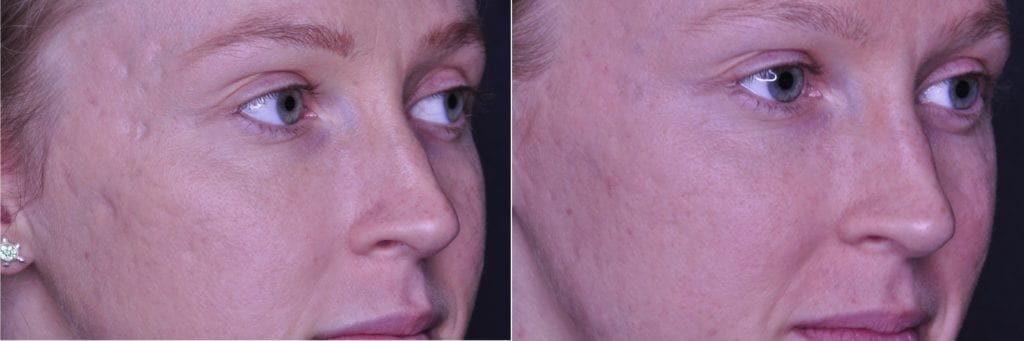 Acne Scar before and after picture