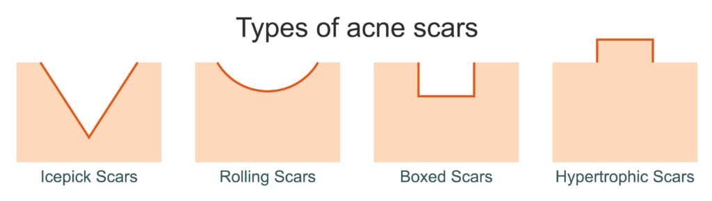 Types of acne scars